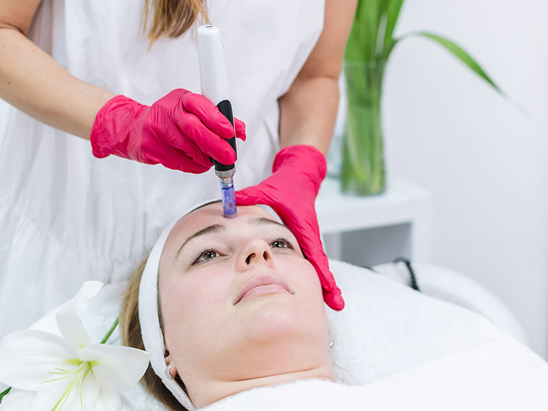 microneedling gallery 01 1