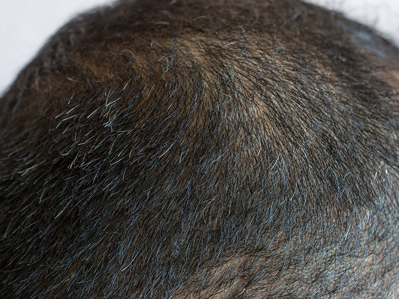 scalp micropigmentation gallery 04