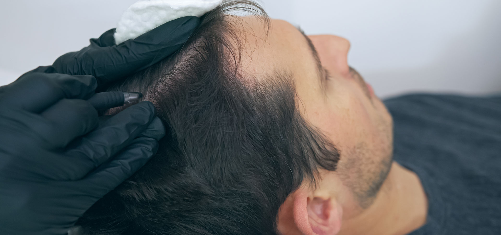 scalp micropigmentation header